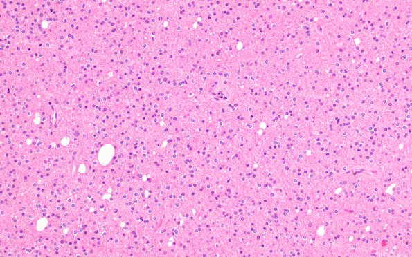 18A1 Oligodendroglioma, WHO II (Case 18) H&E 1