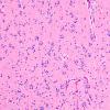 18A2 Oligodendroglioma, WHO II (Case 18) H&E 6