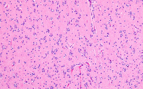 18A2 Oligodendroglioma, WHO II (Case 18) H&E 6