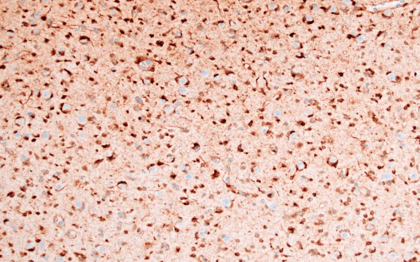 18B Oligodendroglioma, WHO II (Case 18) IDH1 1