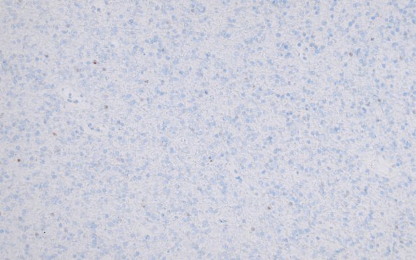 18D Oligodendroglioma, WHO II (Case 18) P53 2