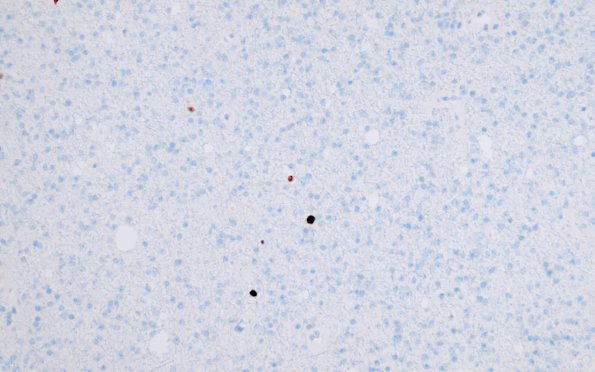 18E Oligodendroglioma, WHO II (Case 18) Ki67 1