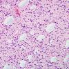 19 Oligodendroglioma, WHO II (Case 19) H&E 2