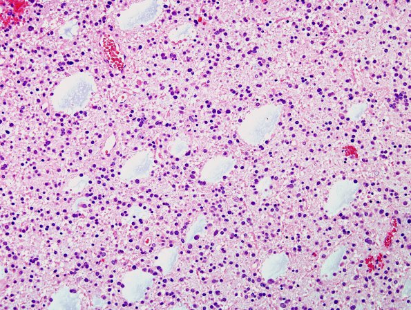 19 Oligodendroglioma, WHO II (Case 19) H&E 2