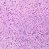 1A1 Oligodendroglioma (Case 1) H&E 1