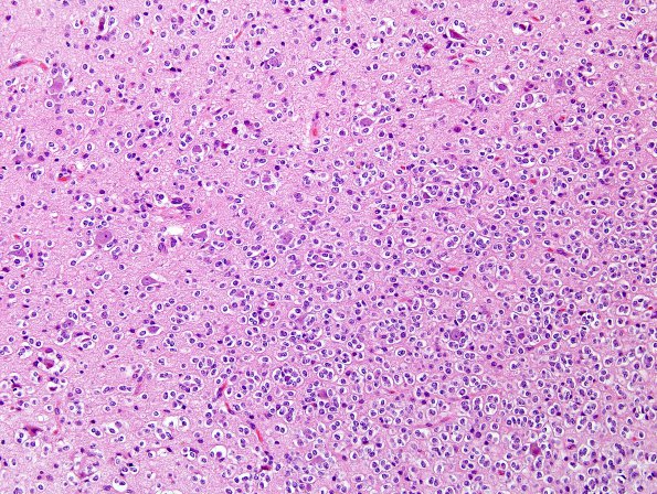 1A1 Oligodendroglioma (Case 1) H&E 1