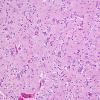 1A2 Oligodendroglioma (Case 1) H&E 6