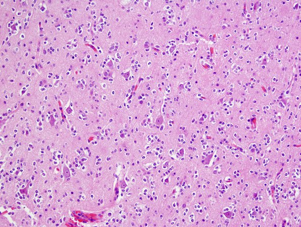 1A2 Oligodendroglioma (Case 1) H&E 6