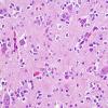 1A3 Oligodendroglioma (Case 1) H&E 5