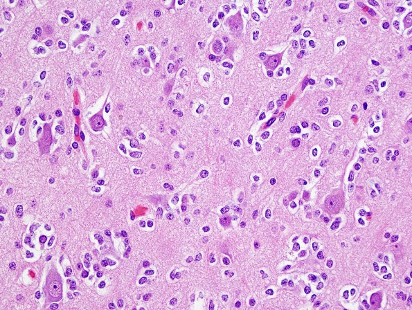 1A3 Oligodendroglioma (Case 1) H&E 5