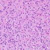 1A4 Oligodendroglioma (Case 1) H&E 2