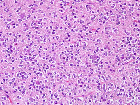 1A4 Oligodendroglioma (Case 1) H&E 2