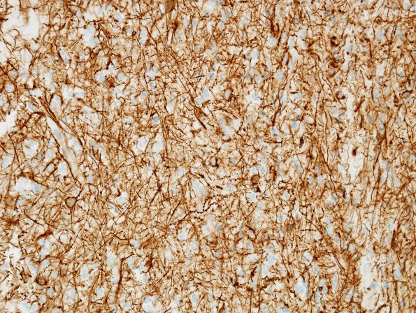 1B Oligodendroglioma (Case 1) GFAP 1