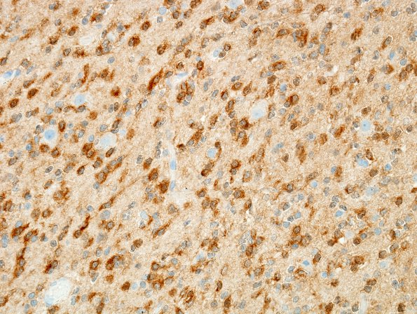 1C1 Oligodendroglioma (Case 1) IDH1 9