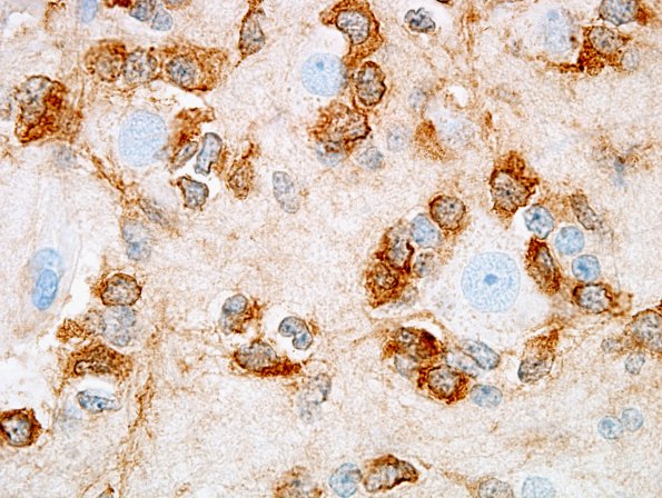 1C2 Oligodendroglioma (Case 1) IDH1 4