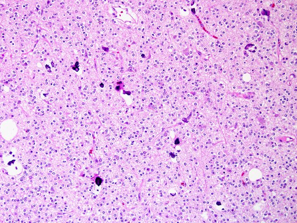 20A1 Oligodendroglioma, WHO II (Case 20) H&E 9.jpg