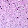 20A2 Oligodendroglioma, WHO II (Case 20) H&E 5.jpg