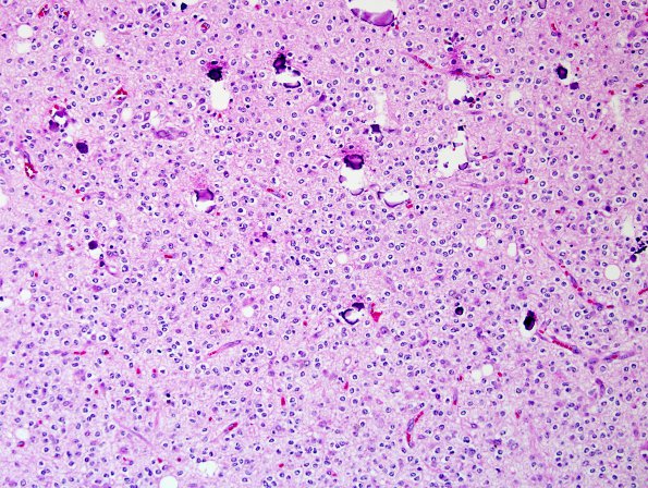 20A2 Oligodendroglioma, WHO II (Case 20) H&E 5.jpg