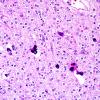 20A3 Oligodendroglioma, WHO II (Case 20) H&E 8.jpg