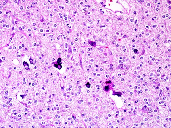 20A3 Oligodendroglioma, WHO II (Case 20) H&E 8.jpg