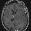 2A1 Oligodendroglioma Grade 2 (Case 2) T1 W - Copy