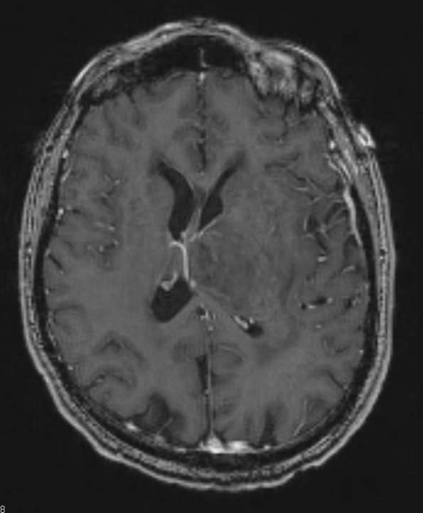 2A1 Oligodendroglioma Grade 2 (Case 2) T1 W - Copy