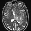 2A2 Oligodendroglioma Grade 2 (Case 2) T2 - Copy