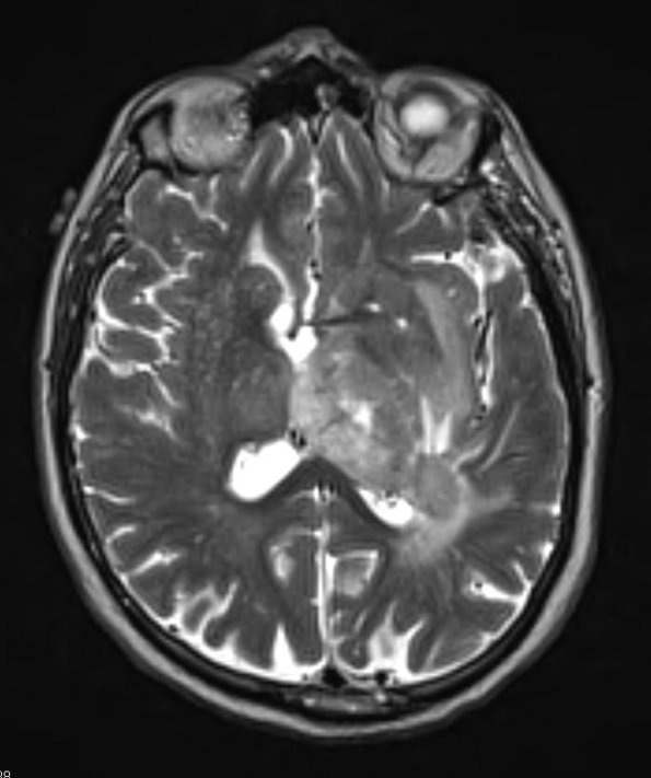 2A2 Oligodendroglioma Grade 2 (Case 2) T2 - Copy