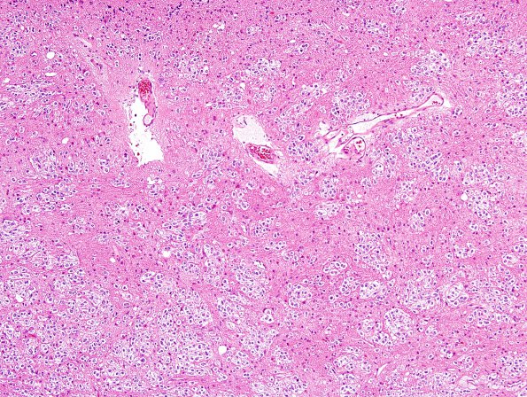 2B1 Oligodendroglioma Grade 2 (Case 2) H&E 10