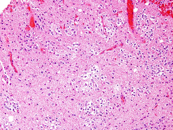 2B2 Oligodendroglioma Grade 2 (Case 2) H&E 1