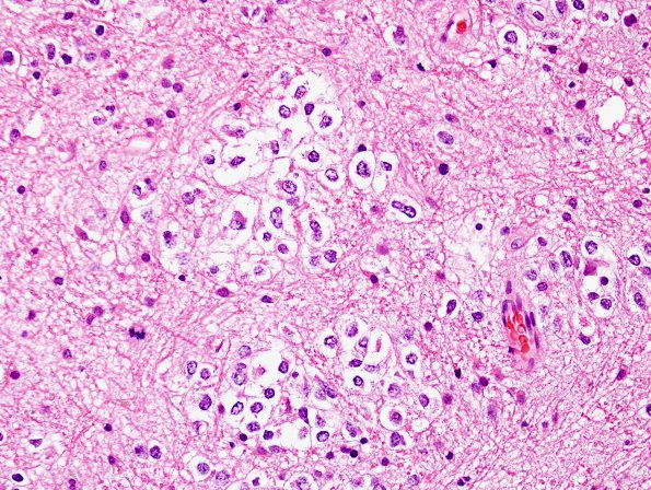 2B3 Oligodendroglioma Grade 2 (Case 2) H&E 2