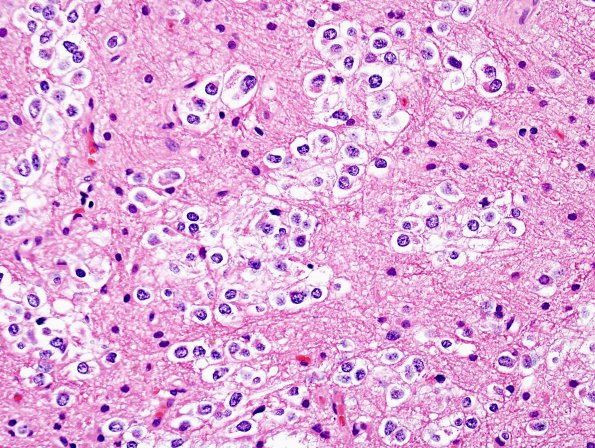 2B4 Oligodendroglioma Grade 2 (Case 2) H&E 8