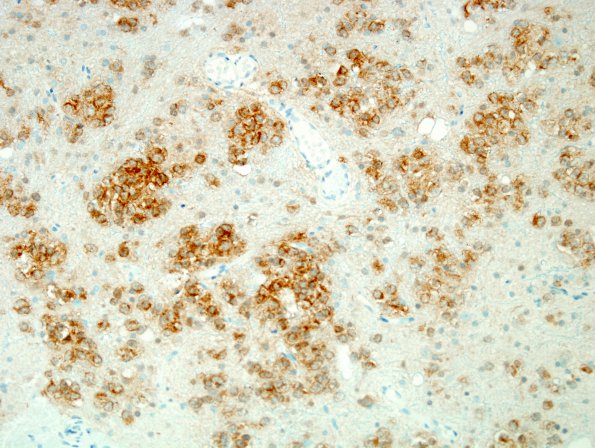 2C1 Oligodendroglioma Grade 2 (Case 2) IDH1 3