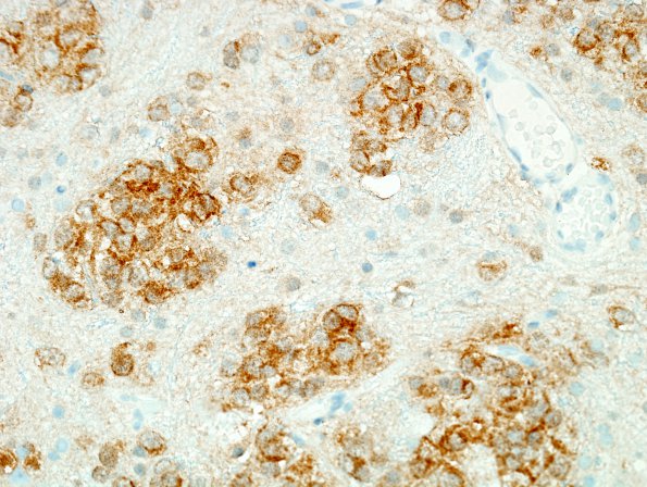 2C2 Oligodendroglioma Grade 2 (Case 2) IDH1 2