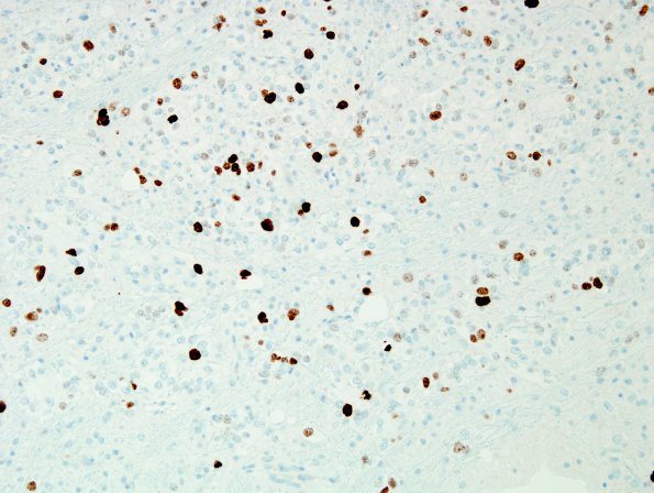 2D Oligodendroglioma Grade 2 (Case 2) MIB 1 1