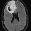 3A1 Oligodendroglioma, Grade 2 (Case 3) FLAIR - Copy