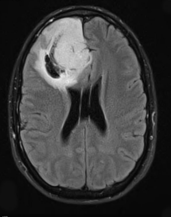 3A1 Oligodendroglioma, Grade 2 (Case 3) FLAIR - Copy