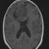 3A2 Oligodendroglioma, Grade 2 (Case 3) T1 W - Copy