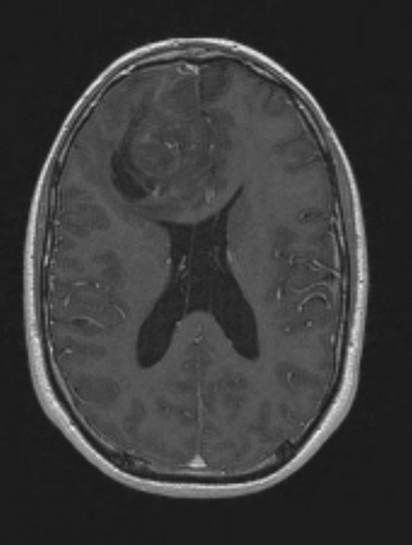 3A2 Oligodendroglioma, Grade 2 (Case 3) T1 W - Copy