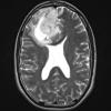 3A3 Oligodendroglioma, Grade 2 (Case 3) T2 W - Copy