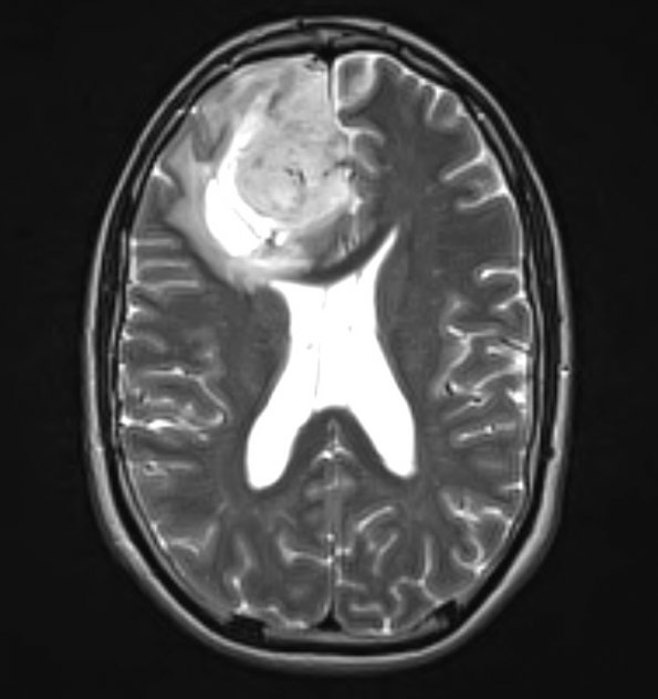 3A3 Oligodendroglioma, Grade 2 (Case 3) T2 W - Copy