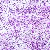 3B2 Oligodendroglioma (Case 3) H&E 5 Smear