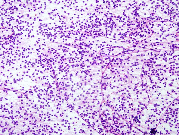 3B2 Oligodendroglioma (Case 3) H&E 5 Smear