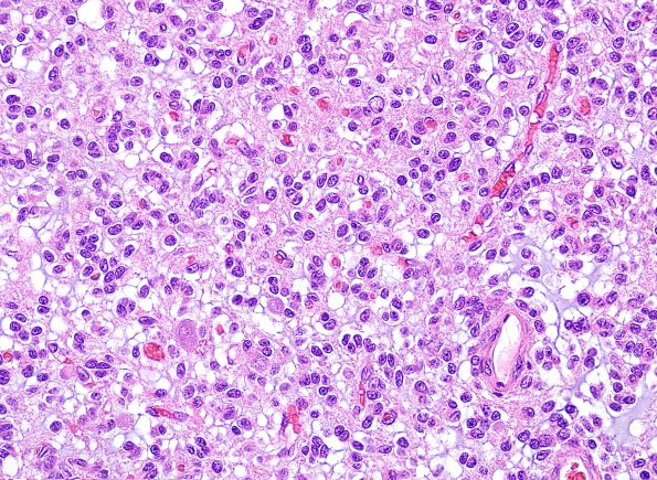 3B3 Oligodendroglioma (Case 3) H&E 9