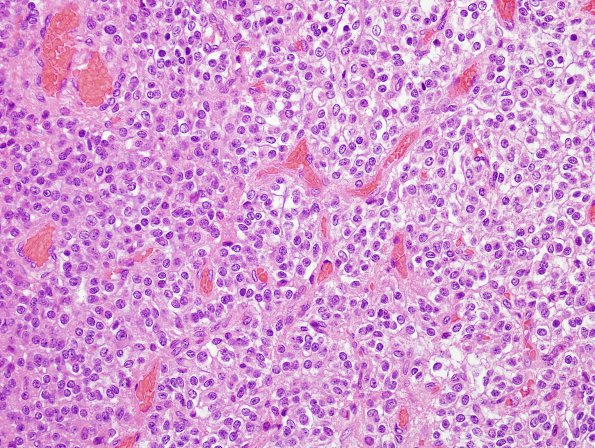 3B4 Oligodendroglioma (Case 3) H&E 13