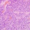 3B5 Oligodendroglioma (Case 3) H&E 15