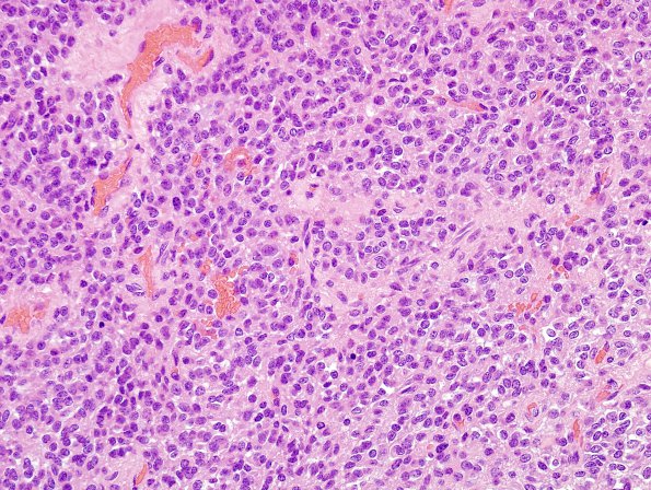 3B5 Oligodendroglioma (Case 3) H&E 15