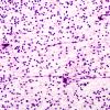 3B6 Oligodendroglioma (Case 3) H&E 1 Smear