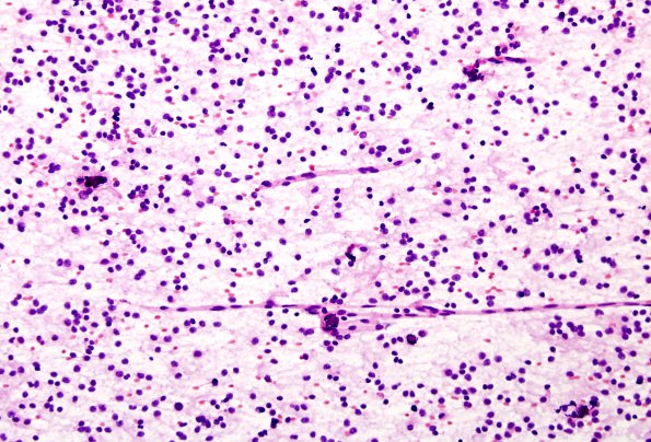 3B6 Oligodendroglioma (Case 3) H&E 1 Smear