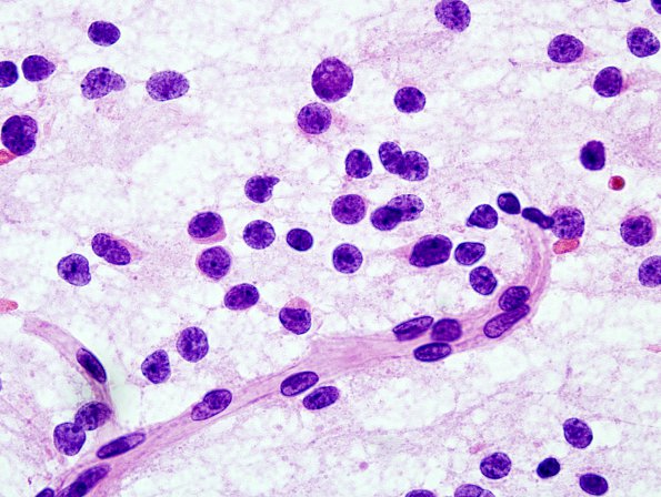 3B7 Oligodendroglioma (Case 3) H&E Smear 100X 1